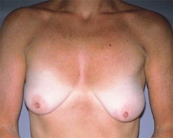 Breast Asymmetry Correction before 281315