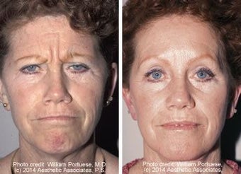 Brow Lift before 91512