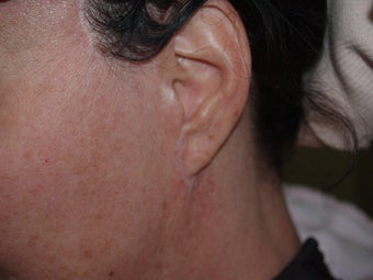 Before and after revision midfacelift before 696086