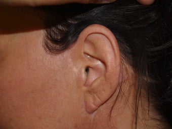 Before and after revision midfacelift after 696086