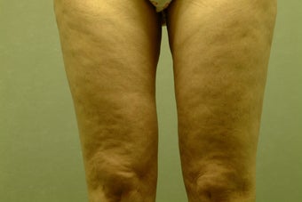 Smart Lipo-Liposuction before 410719
