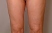 Smart Lipo-Liposuction after 410719