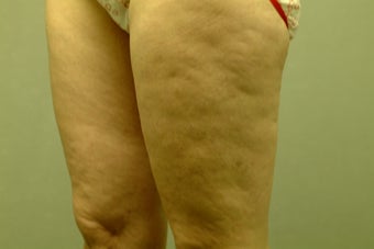 Smart Lipo-Liposuction 410719