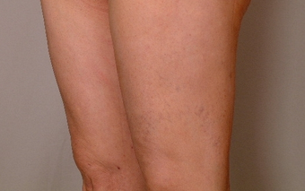 Smart Lipo-Liposuction 410719
