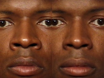 Rhinoplasty before 339214