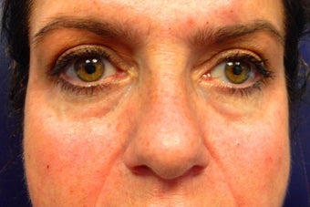 52 year old female treated with Restylane under her eyes before 1328564