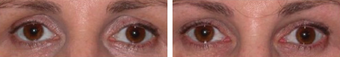 Injectable Treatments before 1200517