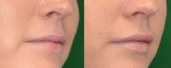 Restylane Filler in Lips before 1306454