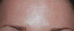 Botox after 283766