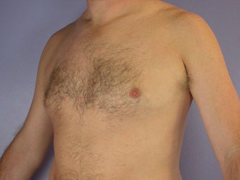 Male Breast Reduction after 285208