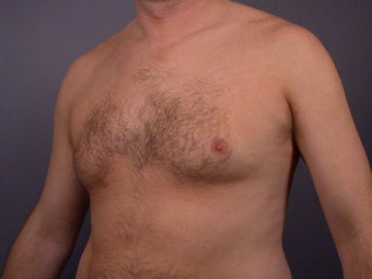Male Breast Reduction before 285208