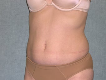 SmartLipo before 607534