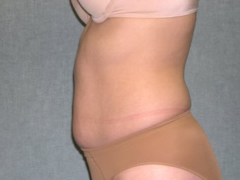 SmartLipo 607534
