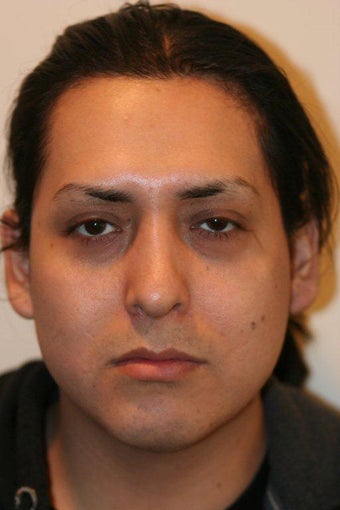 Submental liposuction and revision rhinoplasty after 193476