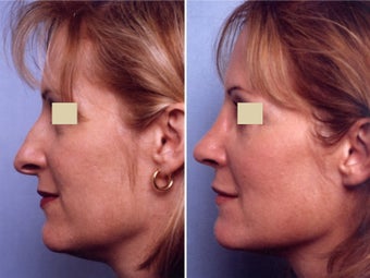 Rhinoplasty before 109660