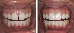 Diastema Dental Bonding before 944867