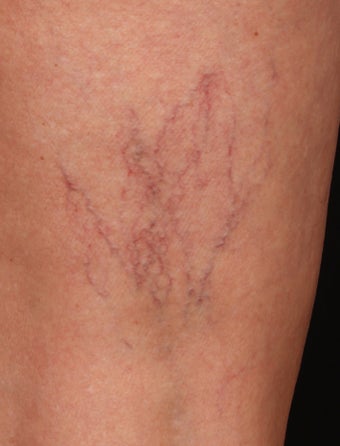 Sclerotherapy for Spider Veins before 1356066