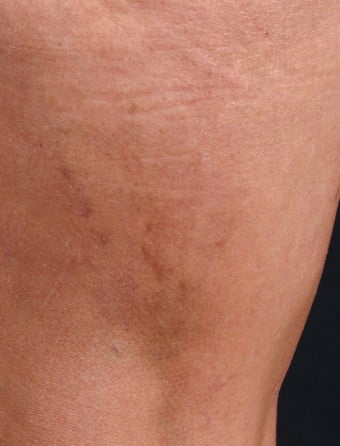 Sclerotherapy for Spider Veins after 1356066