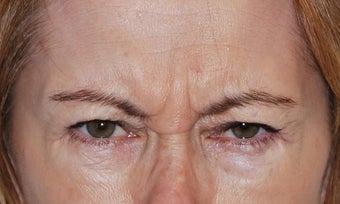 Botox before 949269