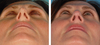 Functional Rhinoplasty before 1208303