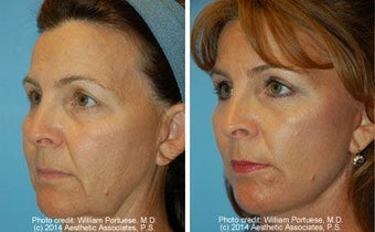 Facelift before 91427