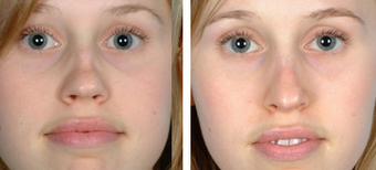 Functional Rhinoplasty before 1208311