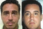 47 year old man presents with eyelid bags and loss of mid-facial volume. before 742616