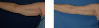Arm lift before 220428