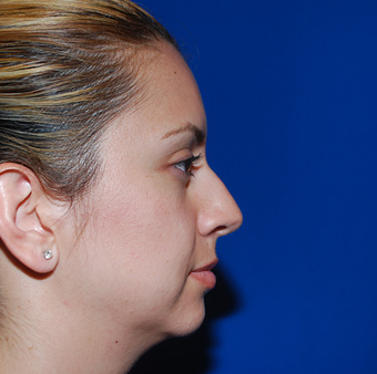 Chin Augmentation before 944861