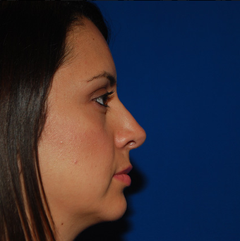Chin Augmentation after 944861