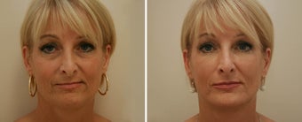 Injectable fillers & Botox Injections before 1291767