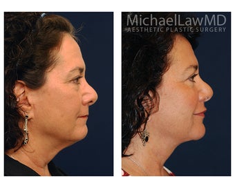 Eye Bag Surgery 886831