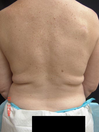 Coolsculpting before 423626