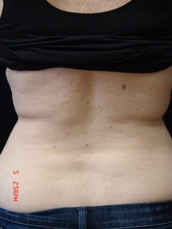 Coolsculpting after 423626
