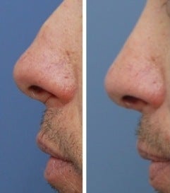 Rhinoplasty before 555765