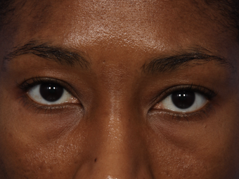 Restylane before 302213