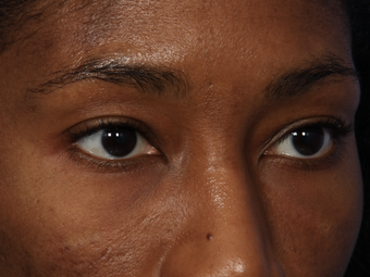 Restylane 302213