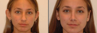 Otoplasty and Rhinoplasty before 95867