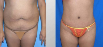Tummy Tuck (Abdominoplasty) before 258052