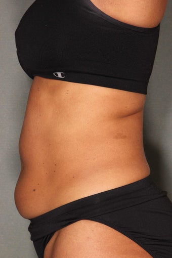 54 Year Old Female Treated for UnWanted Fat With SmartLipo and Vaser Laser High Deffinition before 858933