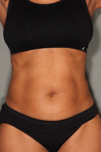 54 Year Old Female Treated for UnWanted Fat With SmartLipo and Vaser Laser High Deffinition 858933