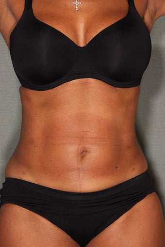 54 Year Old Female Treated for UnWanted Fat With SmartLipo and Vaser Laser High Deffinition 858933