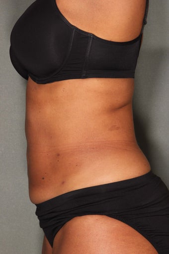 54 Year Old Female Treated for UnWanted Fat With SmartLipo and Vaser Laser High Deffinition after 858933