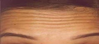Botox before 967786