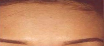 Botox after 967786