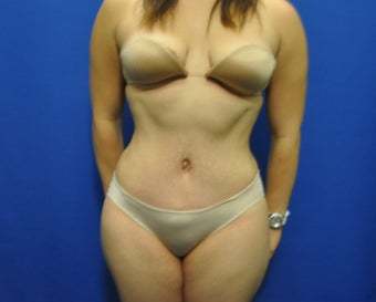 Hourglass Tummy Tuck by Dr. Wilberto Cortes after 371930