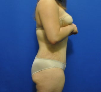 Hourglass Tummy Tuck by Dr. Wilberto Cortes 371930