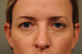 41 Year Old Female with Under Eye Shadows before 975039
