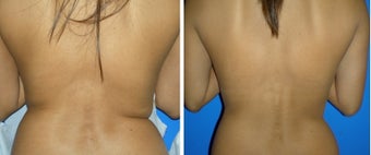 Mesotherapy Before and After before 1010715