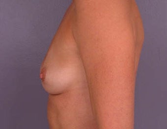 Breast Augmentation before 281424